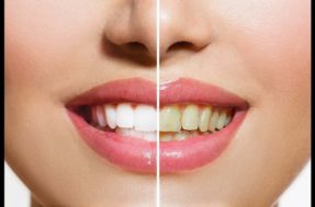 Aprenda a clarear seus dentes com ingredientes naturais