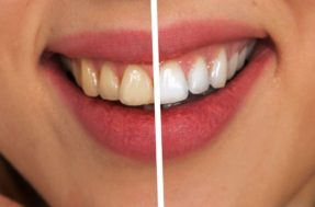 Clareamento dental caseiro dá certo? Veja como deixar os dentes brancos