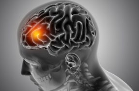 Tumores cerebrais: como identificar através de seus sintomas