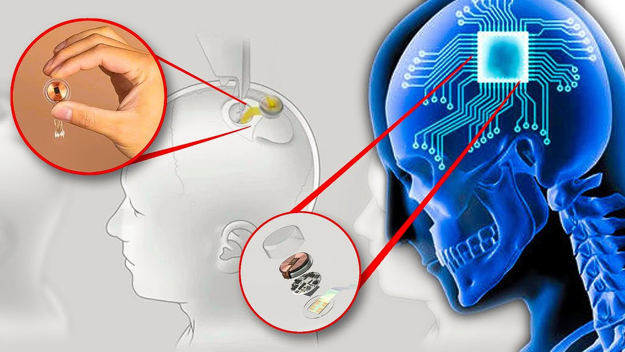 Neuralink Elon Musk Procura Voluntários Para Implantar Chip No Cérebro