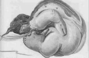 O homem que carregou o feto do irmão na barriga durante 36 anos; veja foto