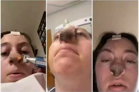 TikTok: ataque de cachorro faz pelos crescerem no nariz desta mulher